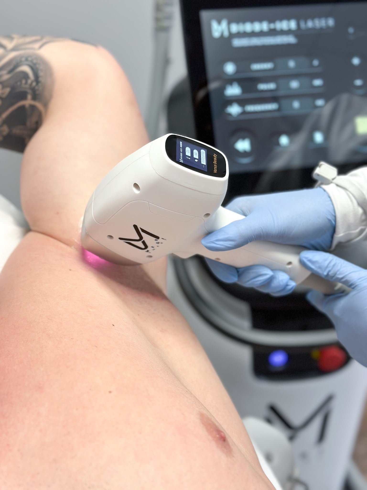 Diode Ice Laser apparaat